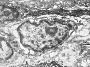 F,41y. | synovial metaplasia - capsule of implantate